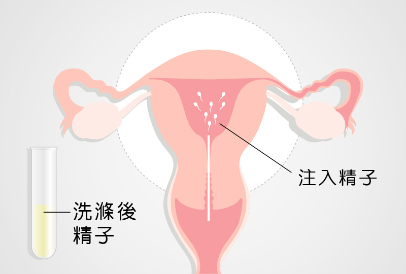 人工受精-安安試管嬰兒中心,不孕症,試管嬰兒,人工受孕,冷凍卵子